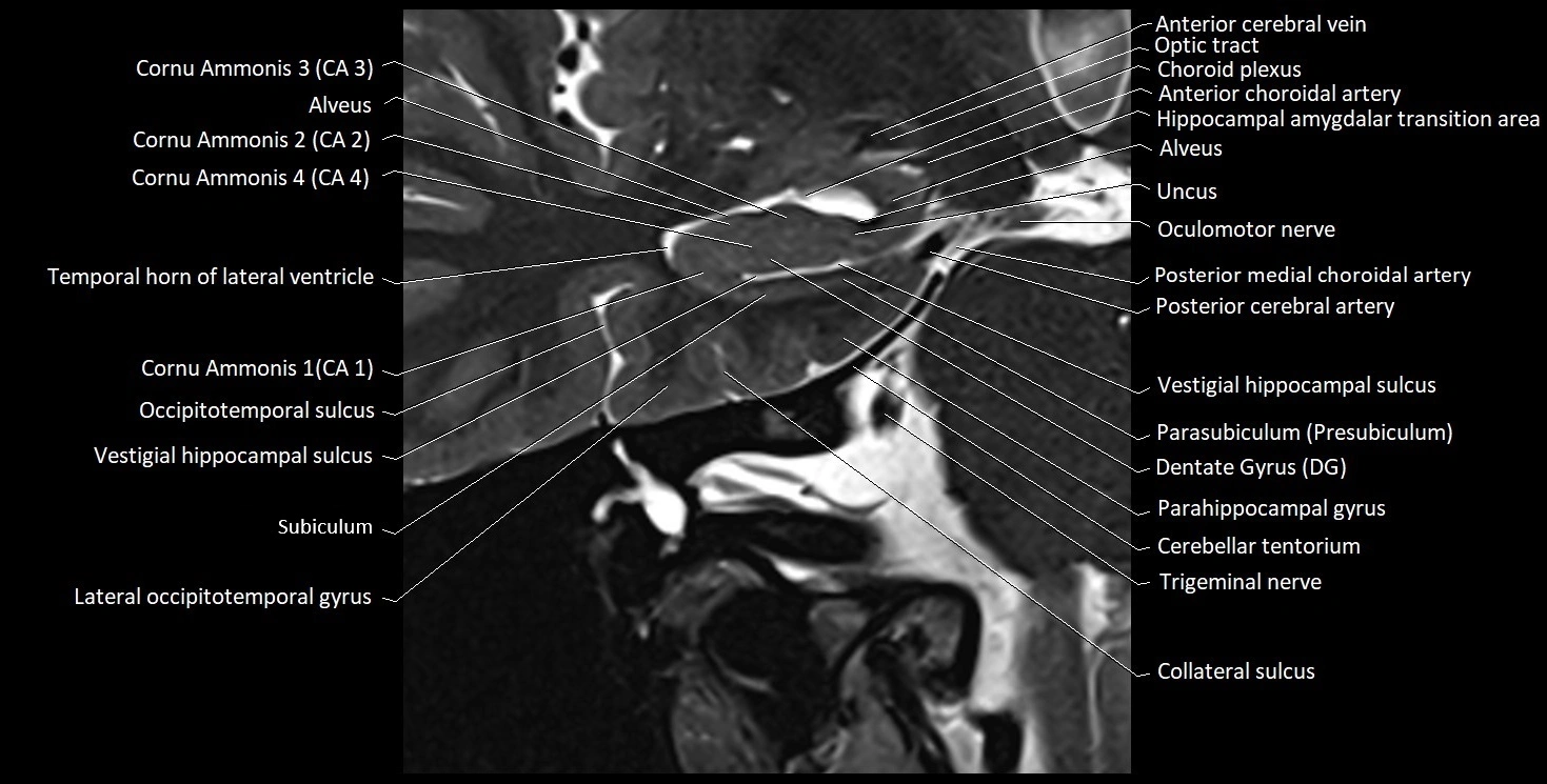 Hippocampus anatomy mri coronal cross section 3T MRI image 4.webp